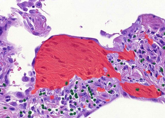 Case study: quantitating histopathological features of idiopathic pulmonary fibrosis