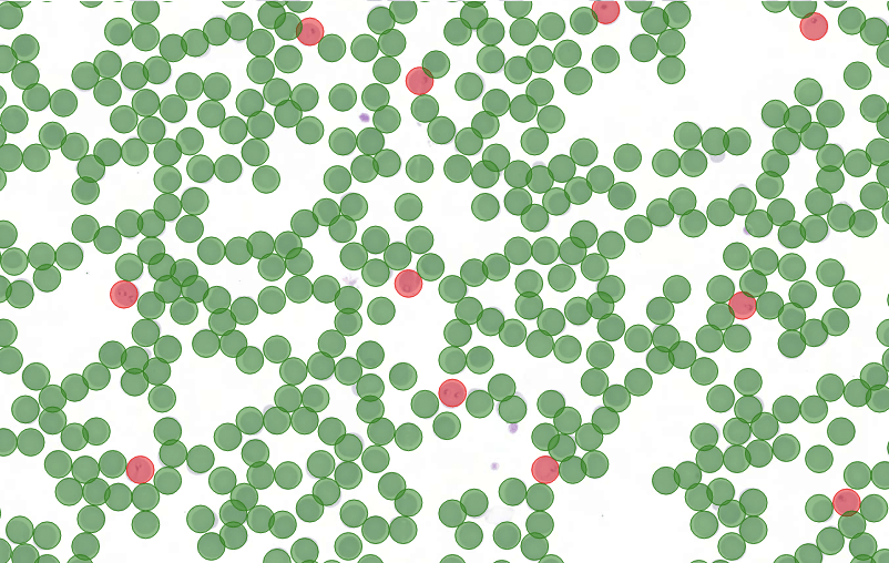 Case study: automating the detection of malaria parasites in blood smear