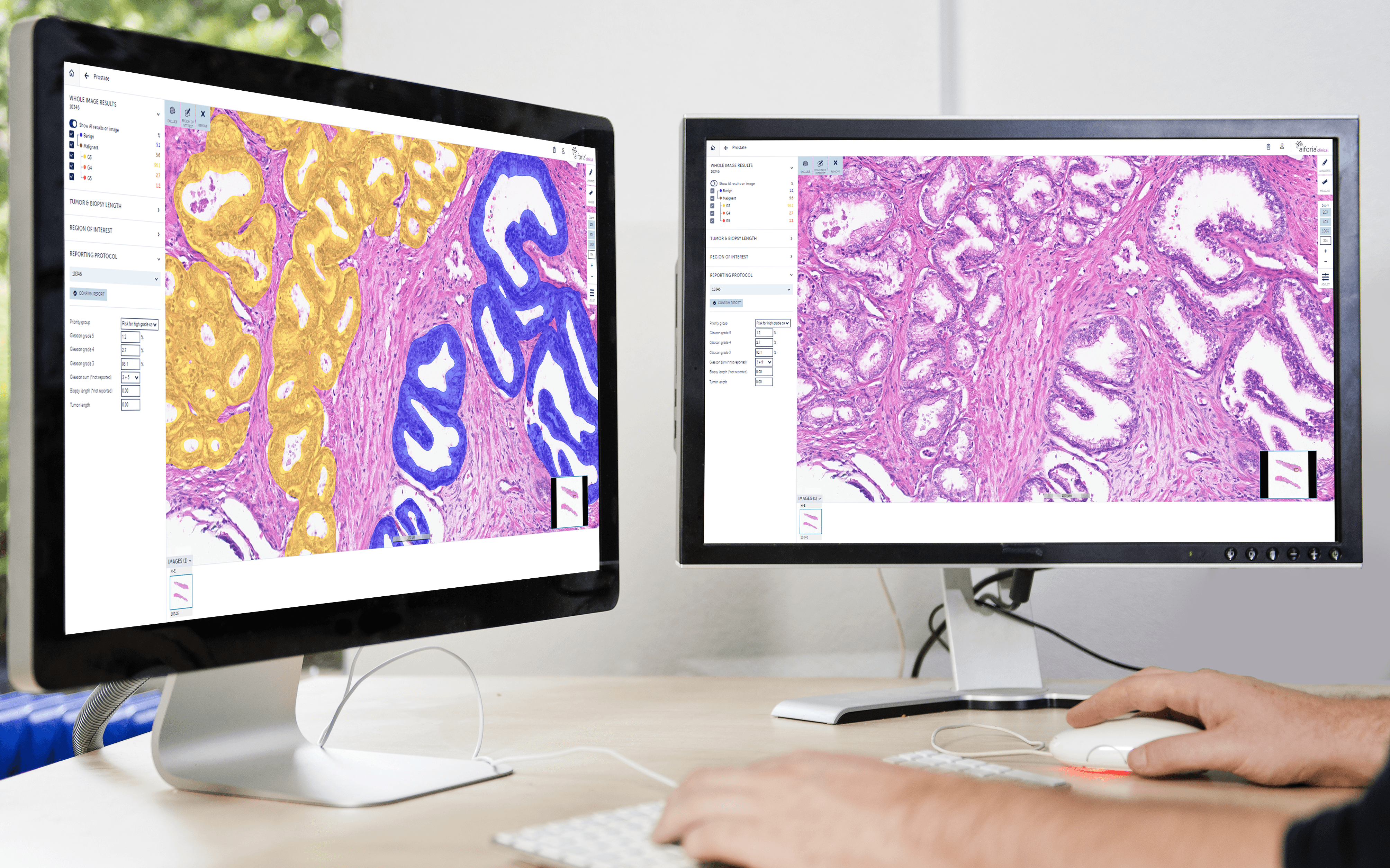 Pathology Image Complex AP-HP has selected Aiforia as a partner for AI-assisted pathology image ...