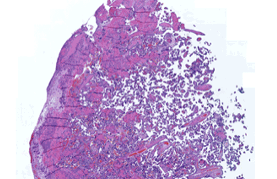 Preeclampsia case study: enhancing reproductive disease research with AI